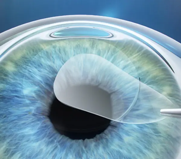 Illustration de la chirurgie refractive pour corriger la vision