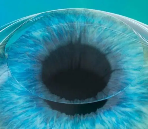 Technologie SMILE pour chirurgie refractive au laser